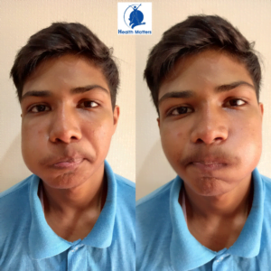 Physiotherapy for Bell’s Palsy Hold air in mouth