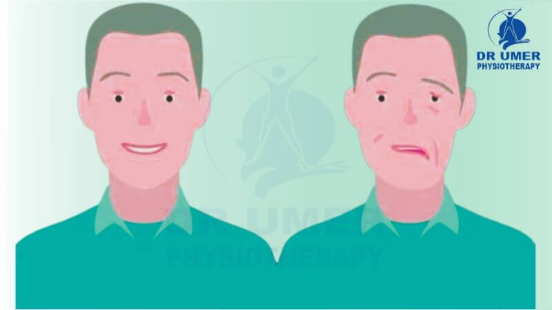 Physiotherapy for Bell’s Palsy