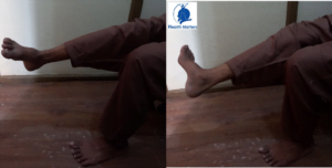 Foot Drop - Physiotherapy for Foot Drop