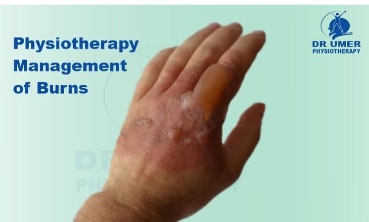 Physiotherapy Management of Burn