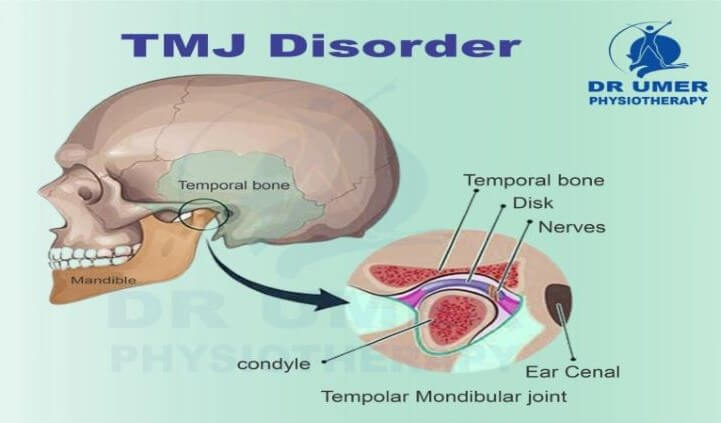TMJ Disorder.