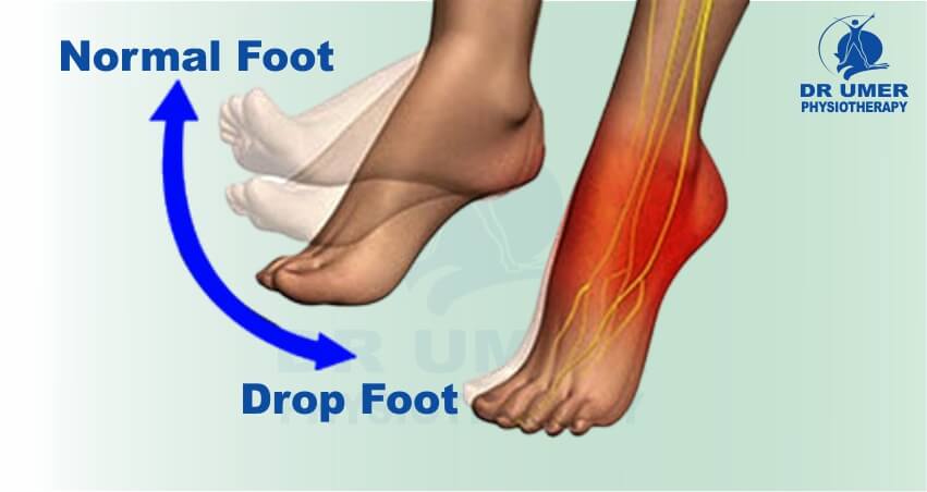 Foot Drop - Physiotherapy for Foot Drop