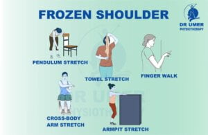 Physiotherapy for Diabetic Patient Frozen shoulder