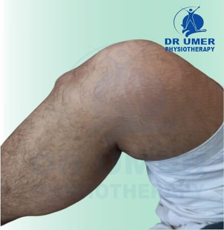 Osgood-Schlatter Disease