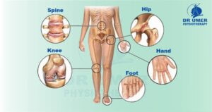 What is Osteoarthritis?