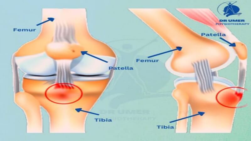 Physical therapy for Osgood Schlatter