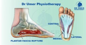 What is Plantar Fasciitis