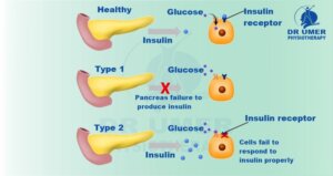 Physiotherapy for Diabetic Patient Types of Diabetes