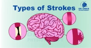 Types of Stroke