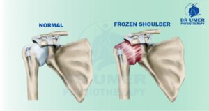 What is Frozen Shoulder