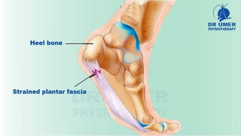 What is Plantar Fascititis