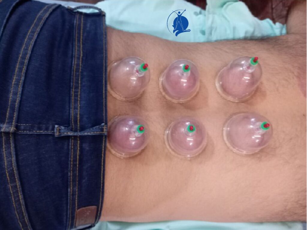 Dry Cupping Therapy