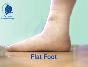 Flat Feet