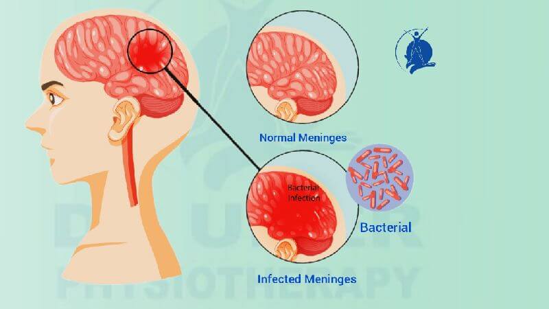 Physiotherapy treatment for Meningitis