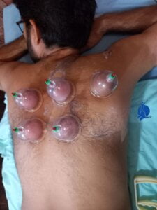 Dry Cupping Therapy Dry Cupping Therapy